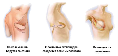 Quanto custa a cirurgia de aumento do busto?