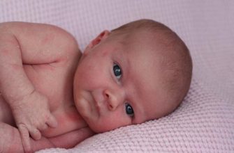 Peau de marbre pour bébés