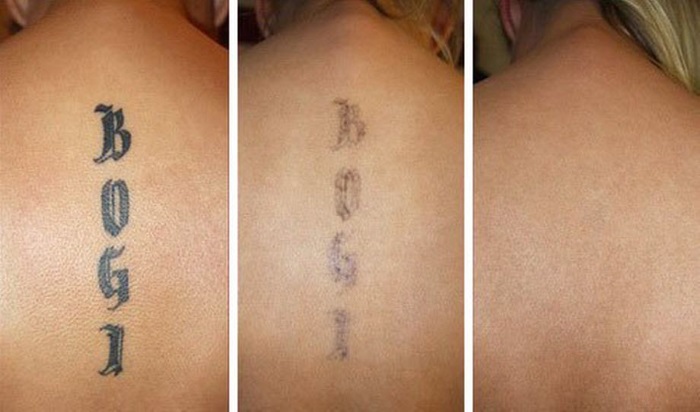 Como tirar uma tatuagem com laser, receitas em casa sem cicatrizes. Fotos antes e depois