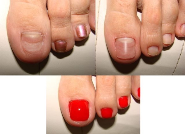 Extensão das unhas dos pés com gel, polygel. Antes e depois das fotos, como fazer