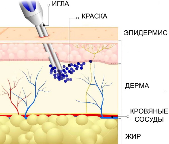 Eliminarea tatuajelor oculare cu laser de la pleoape. Înainte și după fotografii, consecințe