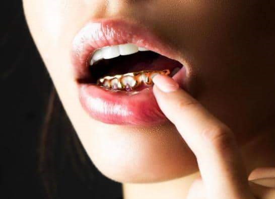 Grelha nos dentes. O que é isso, ouro, prata, diamante, branco. Preço